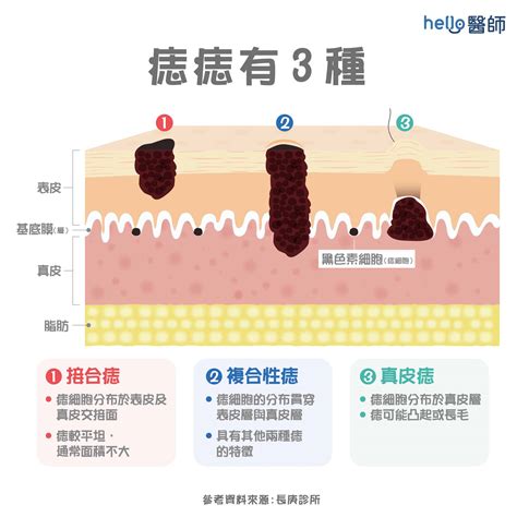 陰莖長痣|生殖部位長痣正常嗎？需要頻繁就醫嗎？